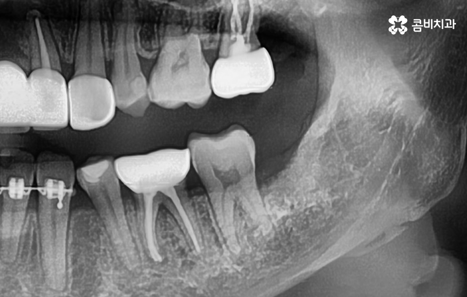 사랑니 어금니 통증 동시에 아프다면 관련 이미지 8
