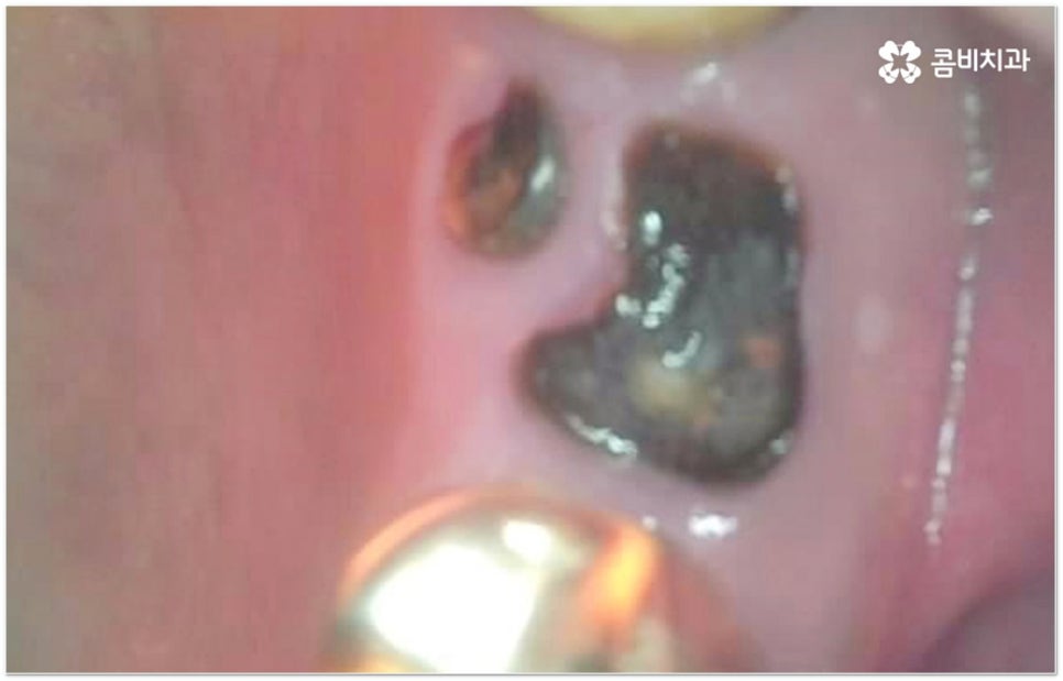 뼈이식임플란트 언제하나요? 관련 이미지 6