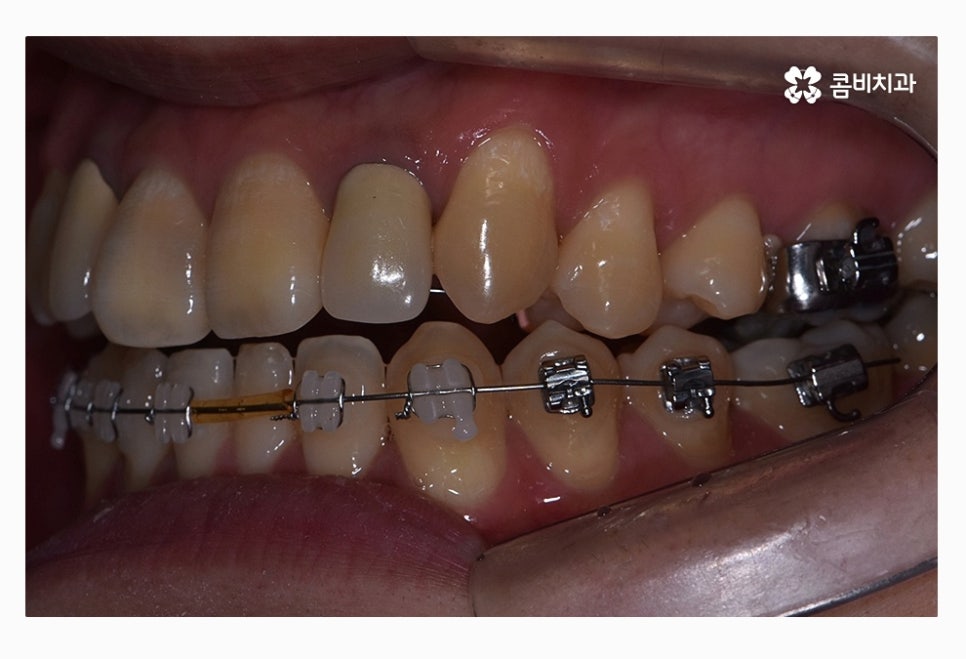 콤비교정 올바르게 판단하려면 관련 이미지 8