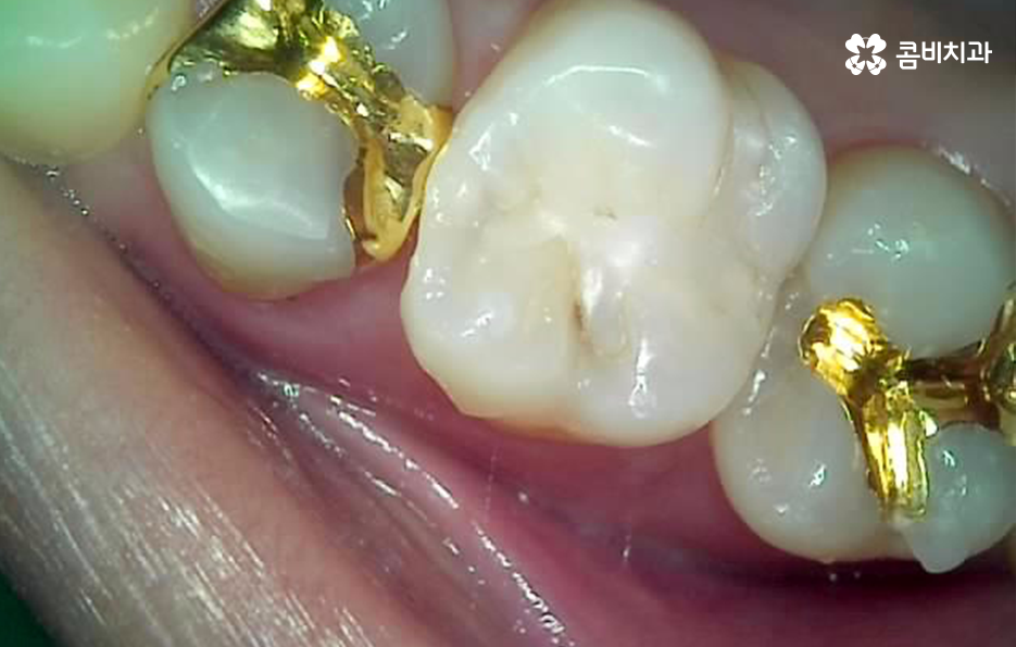 치아 사이 충치 까다로운 이유부터 알아보시죠 관련 이미지 7