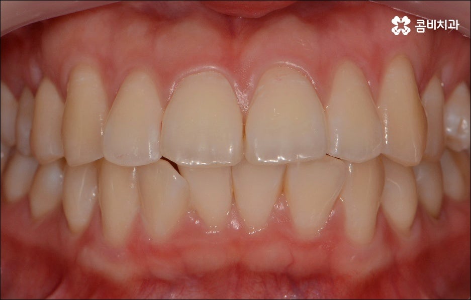 앞니 돌출 어떻게 고치나요? 관련 이미지 3