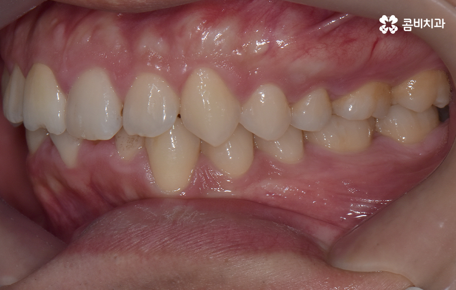 아랫니교정 이렇게만 파악하시면 됩니다 관련 이미지 3