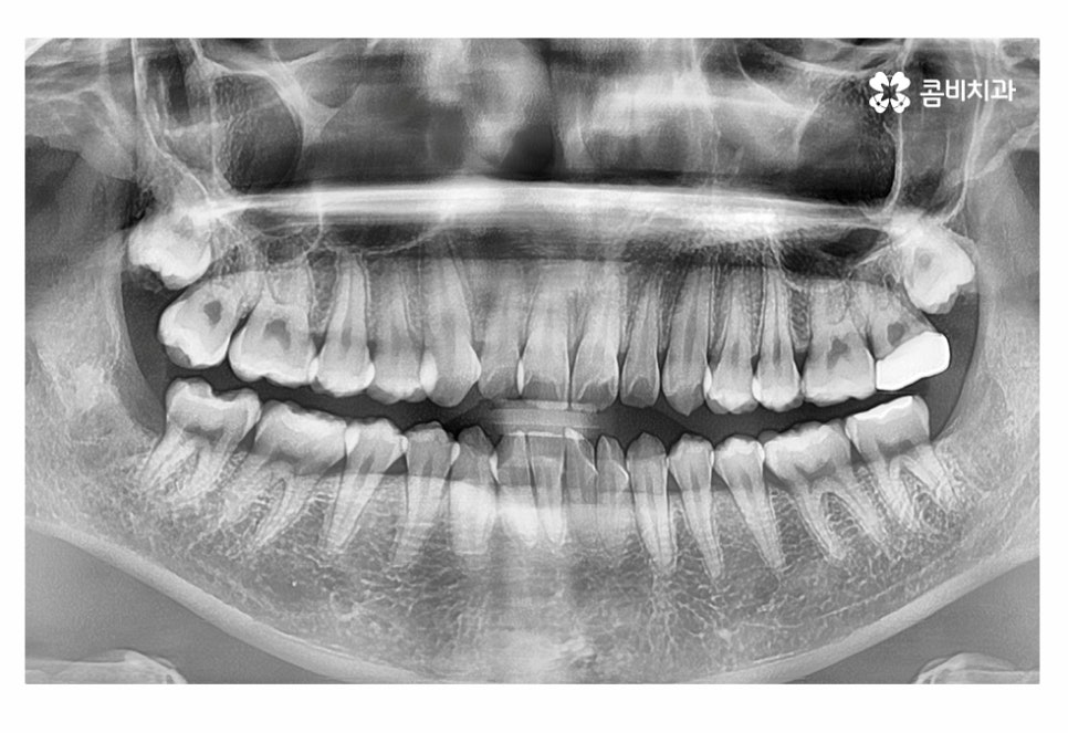 치아부분교정 나도 해당될지 궁금하다면 관련 이미지 4