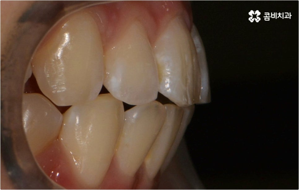 돌출입 치아교정 부모와 아이가 함께 알아봐요 관련 이미지 14