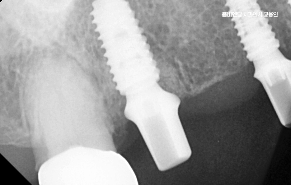 어금니 임플란트 안하면 후회하게 되는걸까 관련 이미지 8