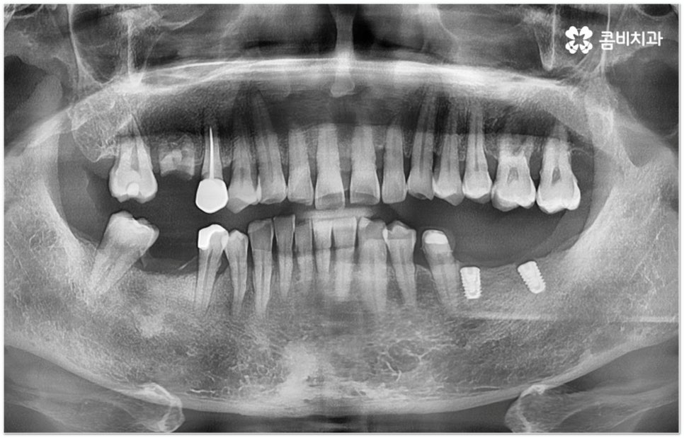 뼈이식임플란트 언제하나요? 관련 이미지 4