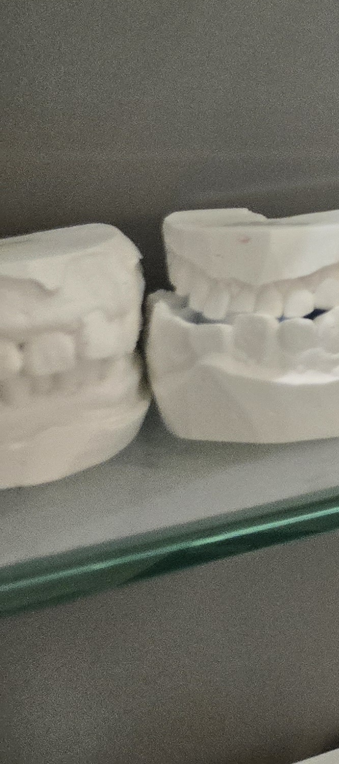 오래된 보철물 아말감 교체 어떠한 케이스일까 관련 이미지 16