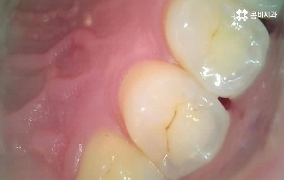 어금니 충치 깨짐 판단기준부터 세워보세요 관련 이미지 2