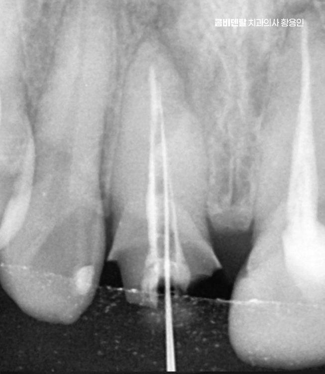 앞니 신경치료 크라운 까지 해야할 상황이라면 관련 이미지 8