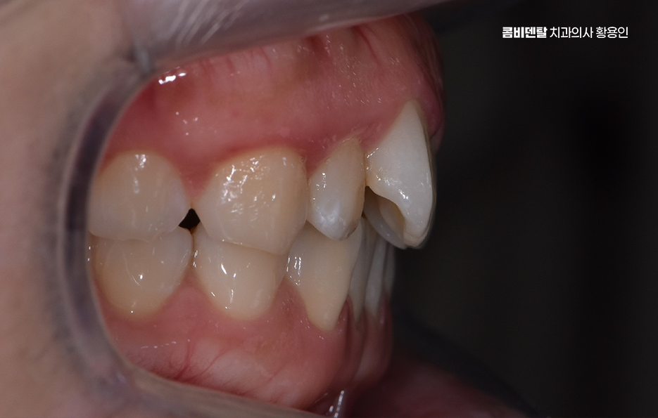 치아교정 통증 줄이는 방법 어떻게 가능할까요 관련 이미지 2