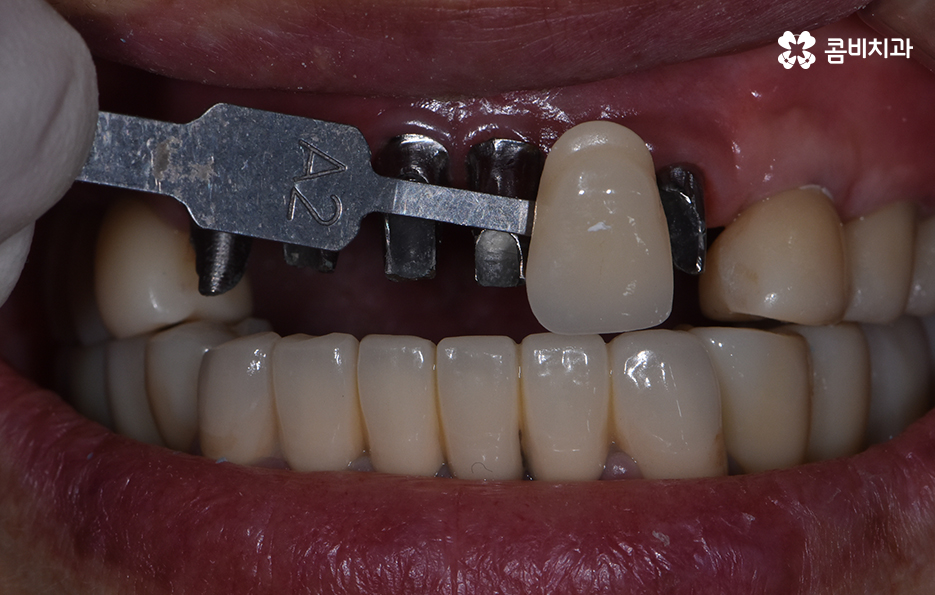 65세이상임플란트 고령이기에 간과하지 말아야 할 사항은 관련 이미지 10