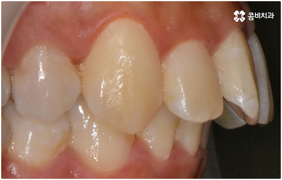 돌출치아교정 언제가 좋을까요 관련 이미지 2