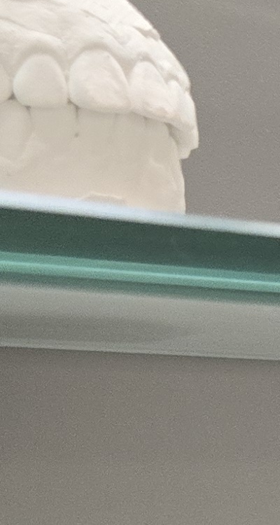 앞니 틀어짐 부분교정 얼마나 걸릴까 관련 이미지 24