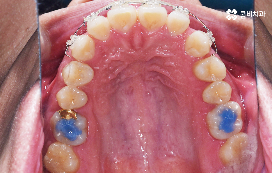 치아부분교정 내게도 적합한지 알아보려면 관련 이미지 7