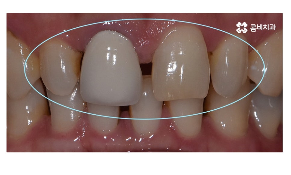 무삭제라미네이트 포인트부터 잘 알고 시작하려면 관련 이미지 2
