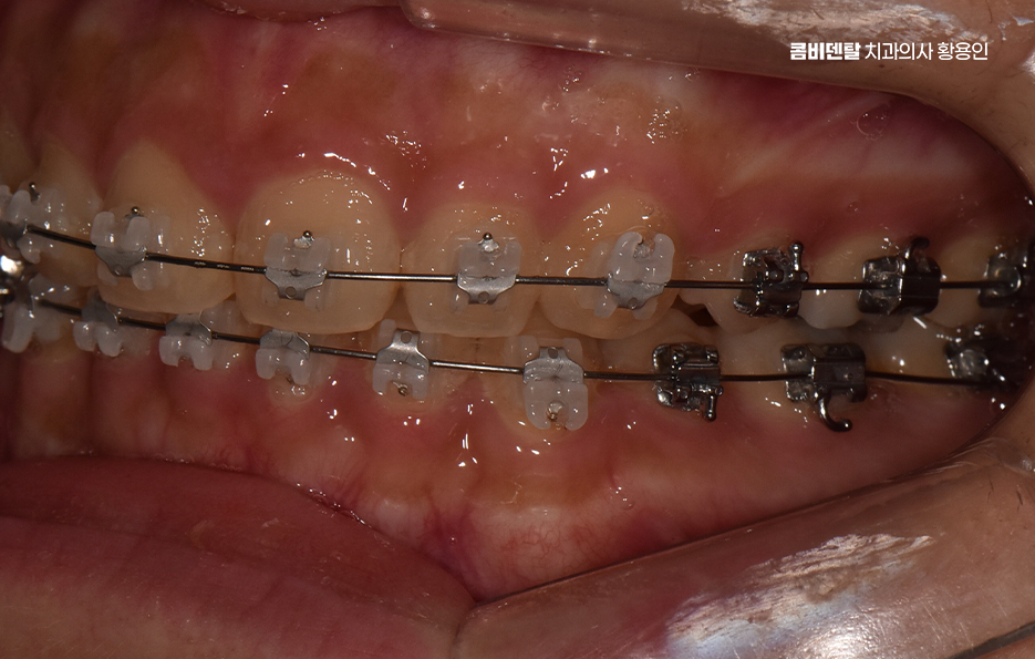 과개교합 교정 후 얼굴형 얼마나 바뀌나요 관련 이미지 8