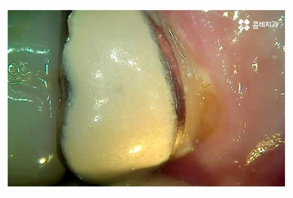 20대임플란트 갈수록 늘어나는 이유는 관련 이미지 4