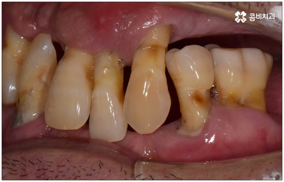 노인임플란트 참고사항 알아봐요 관련 이미지 5