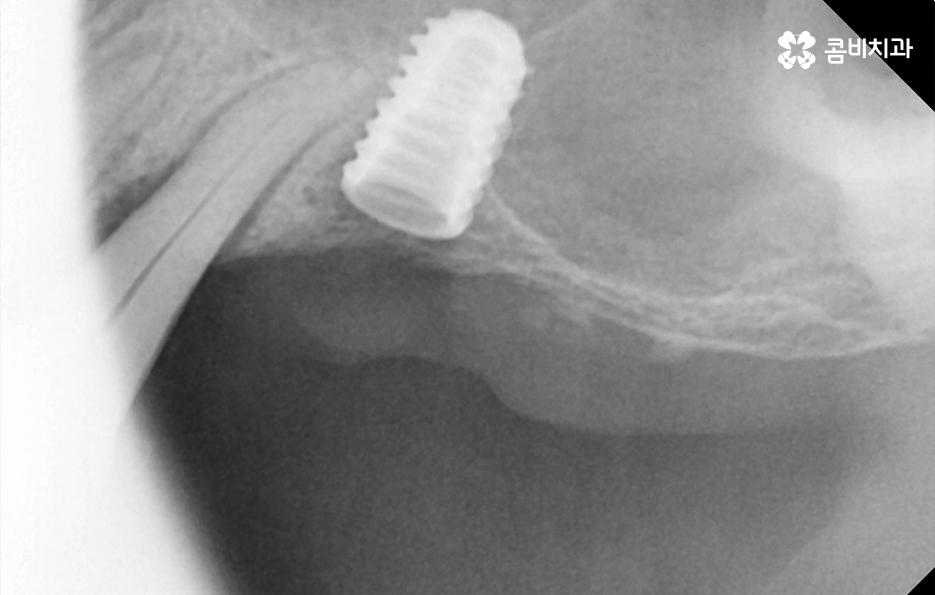 50대임플란트 각별하게 주의해야 하는 시기 관련 이미지 7