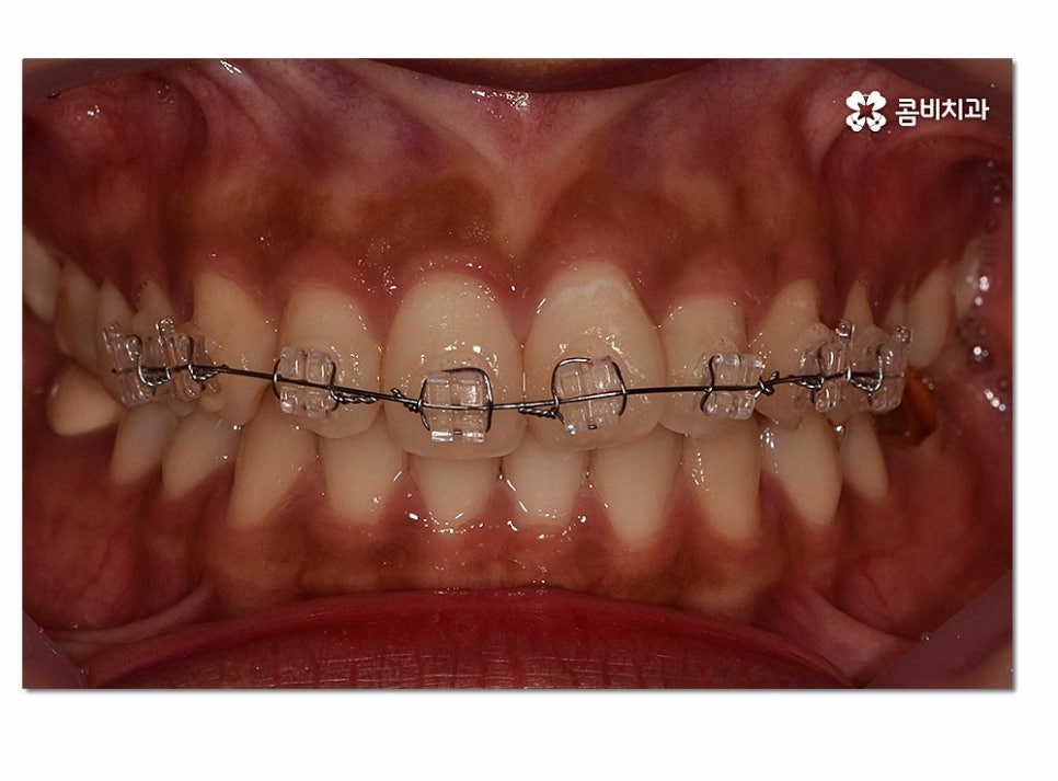 앞니 부분교정 오래 걸리지 않고 원하는 부위만 관련 이미지 6