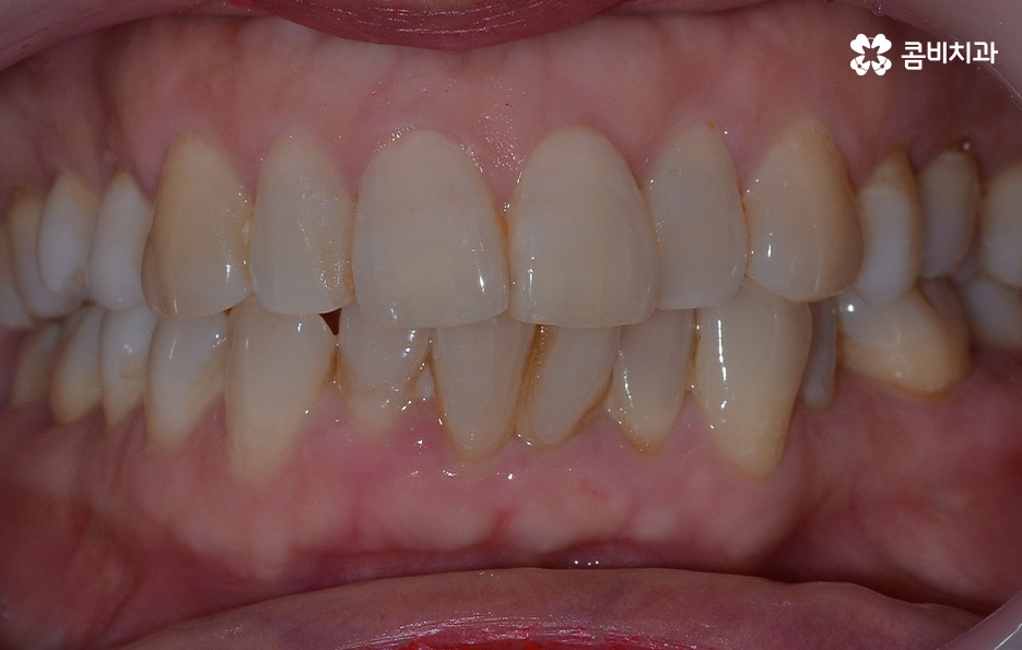 돌출입 콤비교정으로 얼굴까지 개선하는 방법은 관련 이미지 1