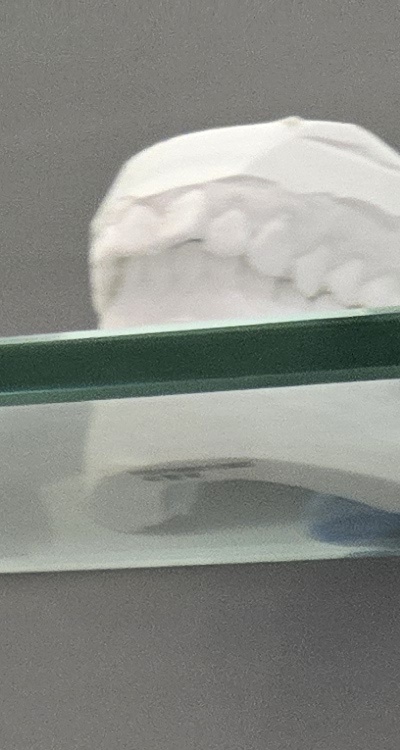 윗니 전체 임플란트 뭐부터 해야할까 관련 이미지 15