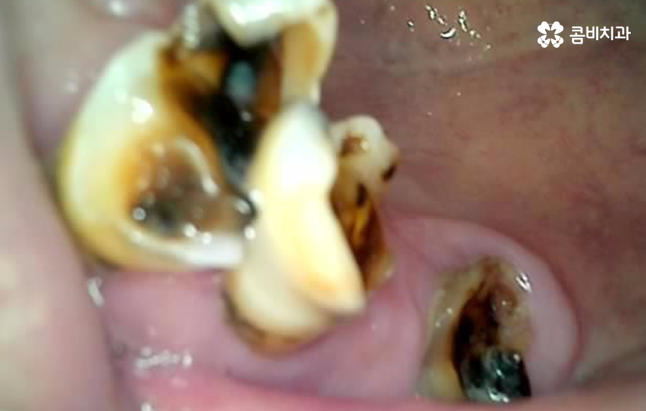 65세이상 임플란트 개수 구체적으로 체크하려면 관련 이미지 3