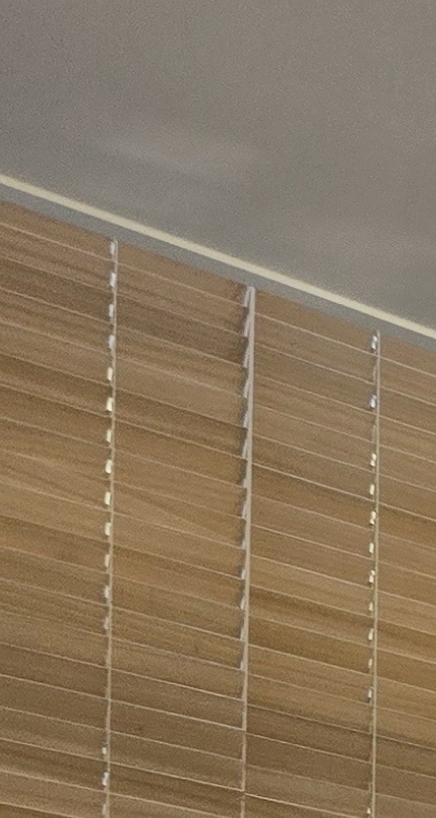 돌출입 팔자주름 교정 얼마나 바뀔까요 관련 이미지 13