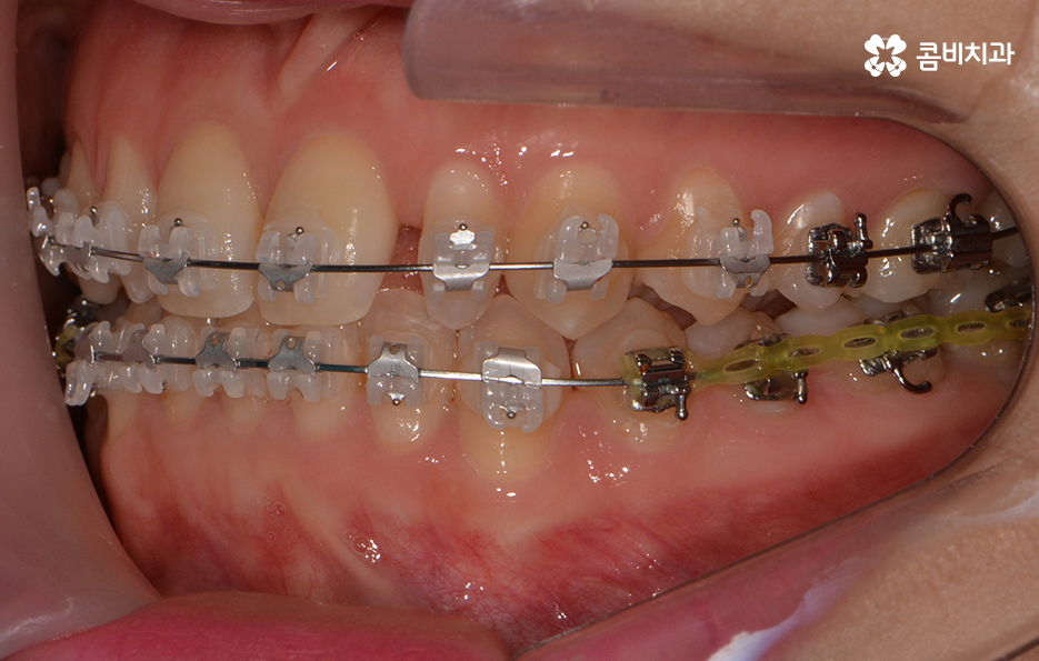 앞니 깨짐 치료와 교정이 병행되었던 사례 관련 이미지 7