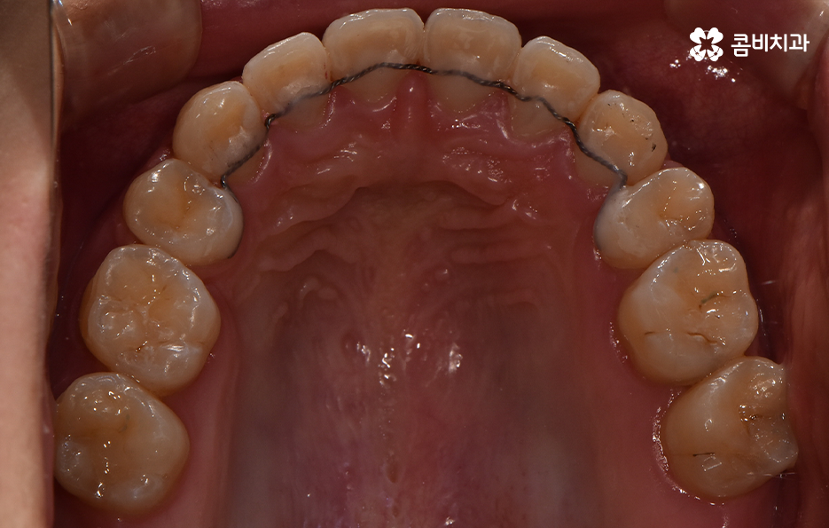 돌출입발치교정 기대해봐도 될까요 관련 이미지 14