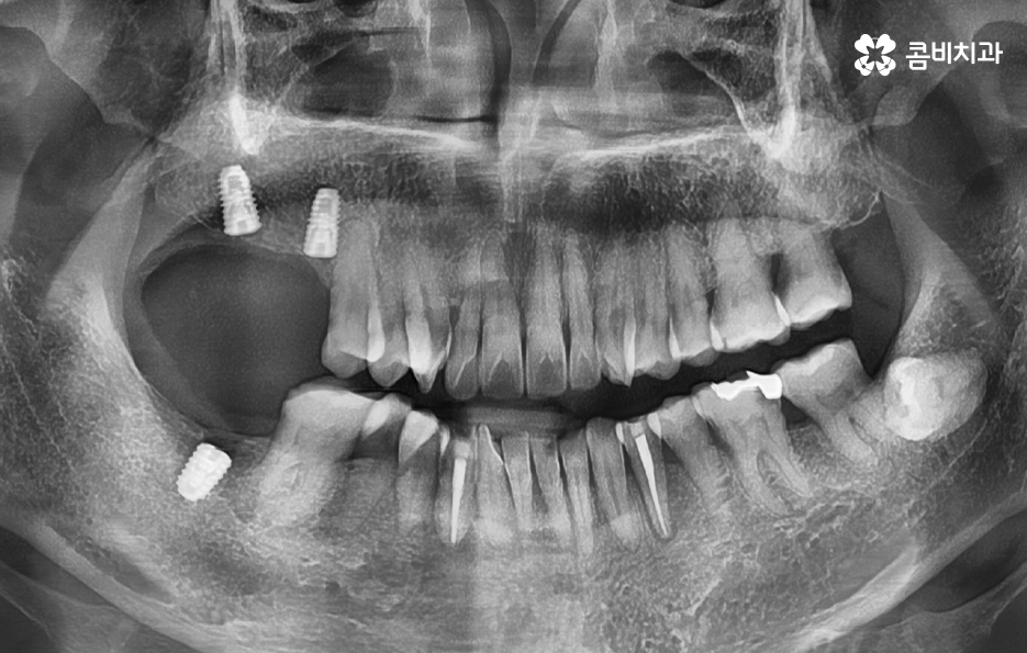 어금니 임플란트 기간 얼마나 예상해야 하나요 관련 이미지 2