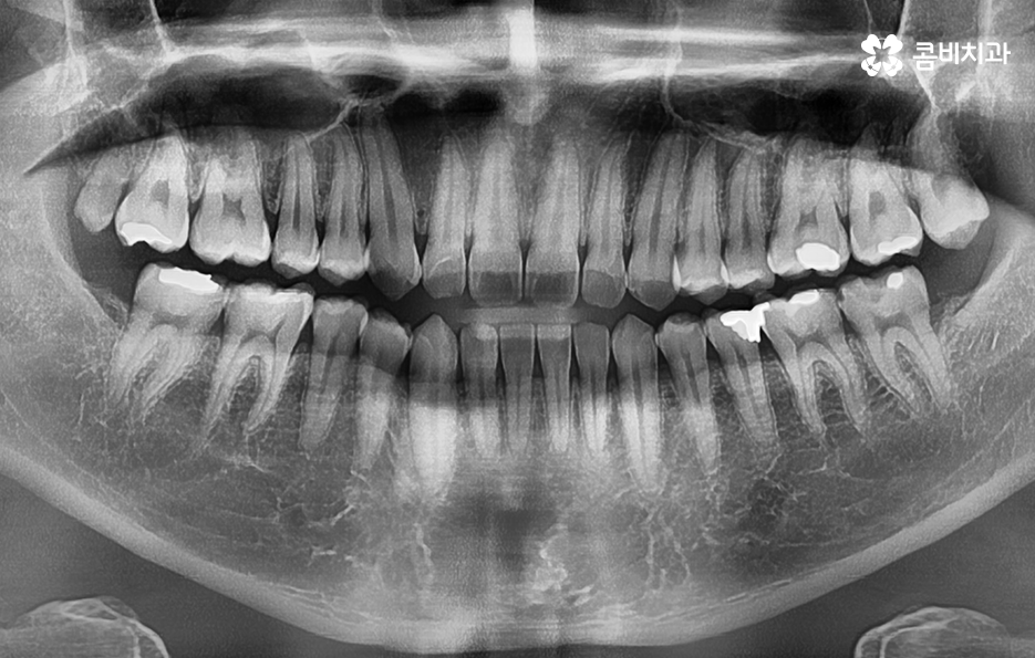 어금니 충치 깨짐 판단기준부터 세워보세요 관련 이미지 1