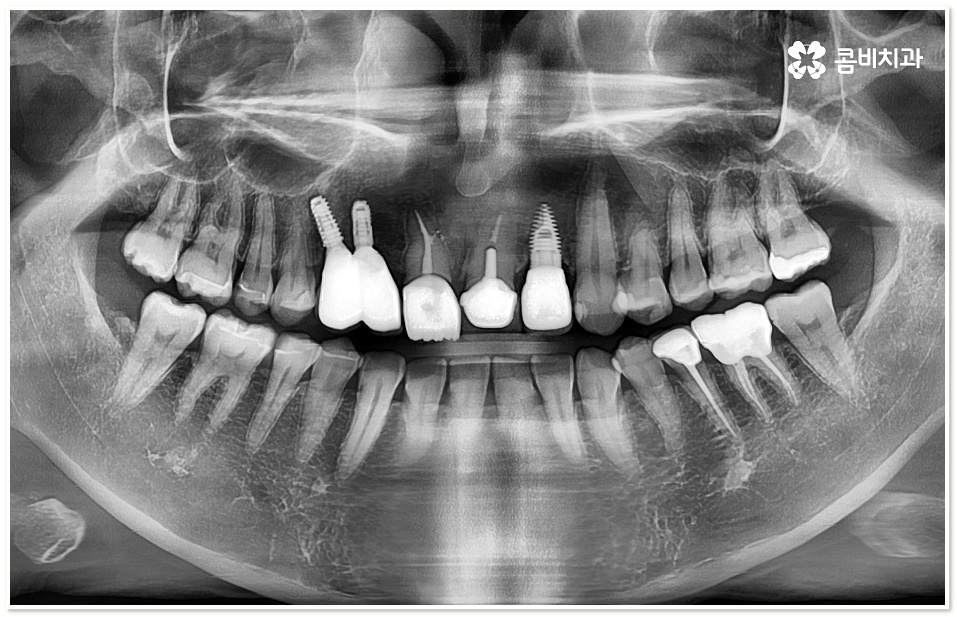 앞니임플란트 체크할 사항들은? 관련 이미지 3