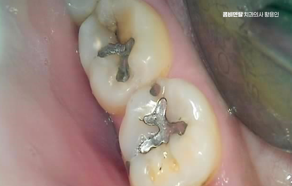 아말감 교체 시기 이렇게 따져보세요 관련 이미지 11
