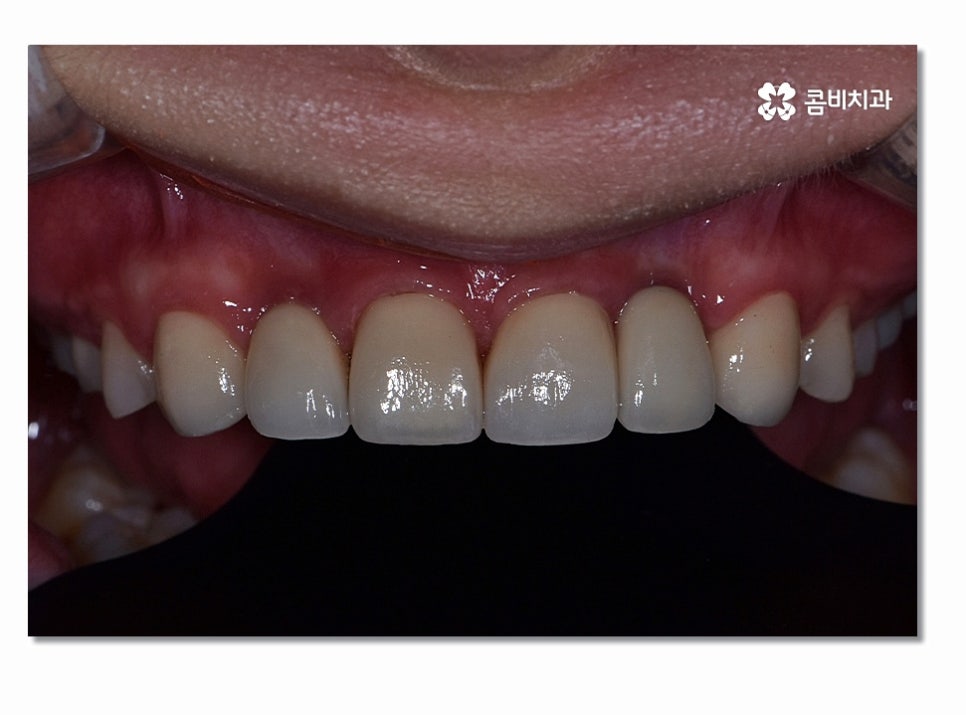 앞니임플란트 합리적으로 접근하려면 관련 이미지 9
