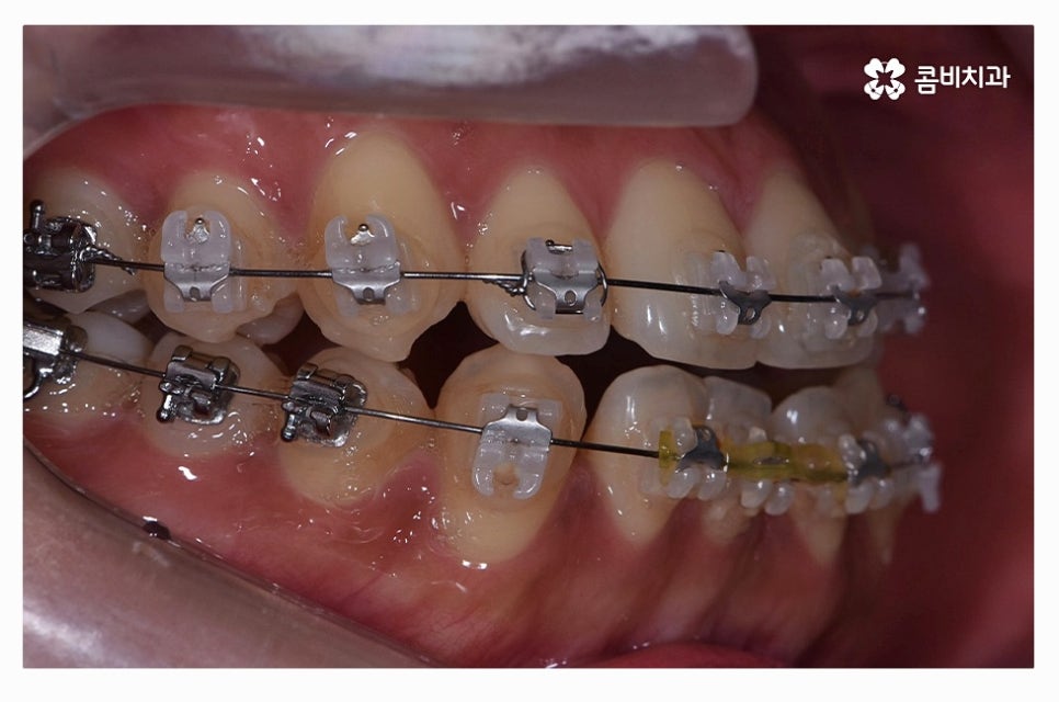덧니교정 정교하게 따져보려면 관련 이미지 8
