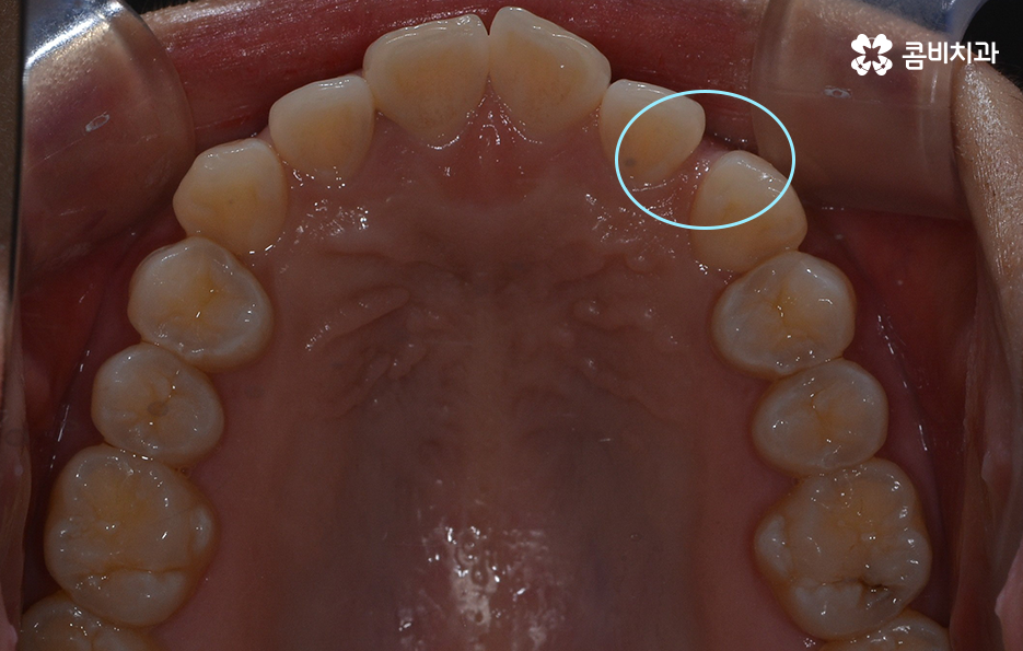 비발치치아교정 고민되는데 발치하면 안좋나요 관련 이미지 4