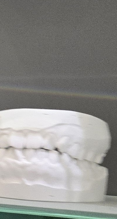 윗니 전체 임플란트 뭐부터 해야할까 관련 이미지 27