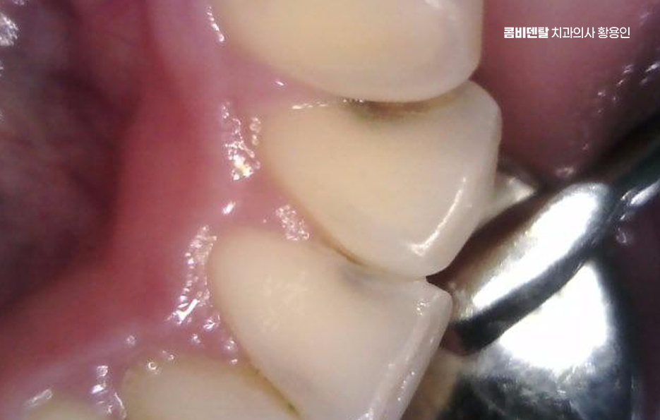 Be Careful Not to Delay Treatment for Cavities Between Your Teeth image 7