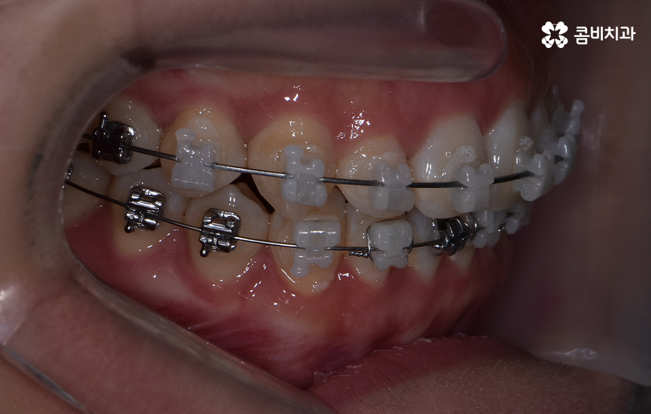 비발치치아교정 고민되는데 발치하면 안좋나요 관련 이미지 10