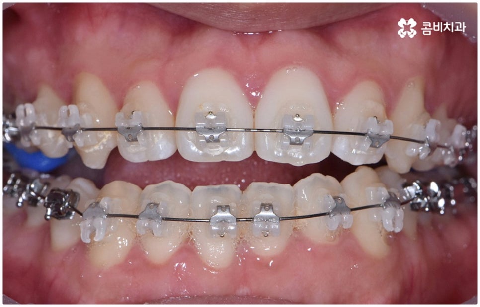 부정교합 3급 왜 고쳐야 하나요 관련 이미지 7
