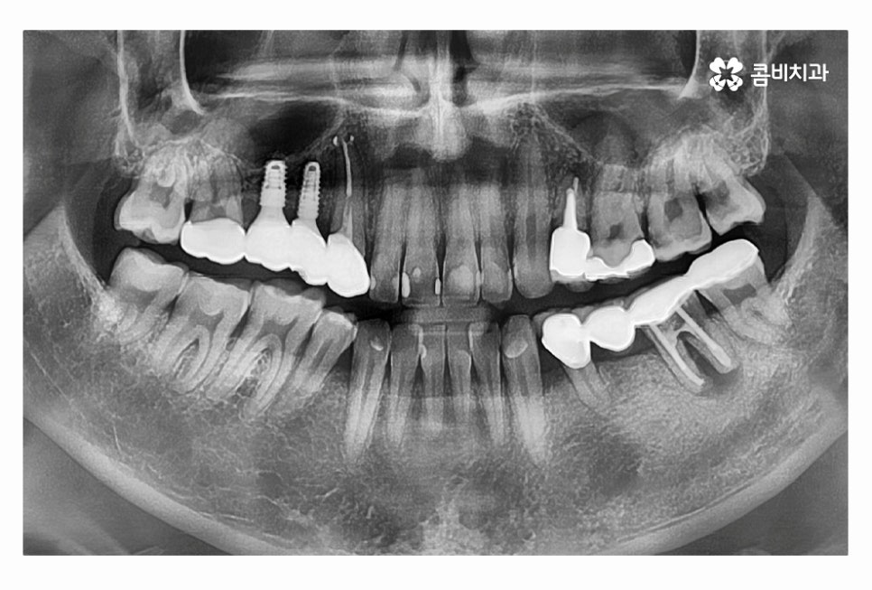 20대임플란트 갈수록 늘어나는 이유는 관련 이미지 12