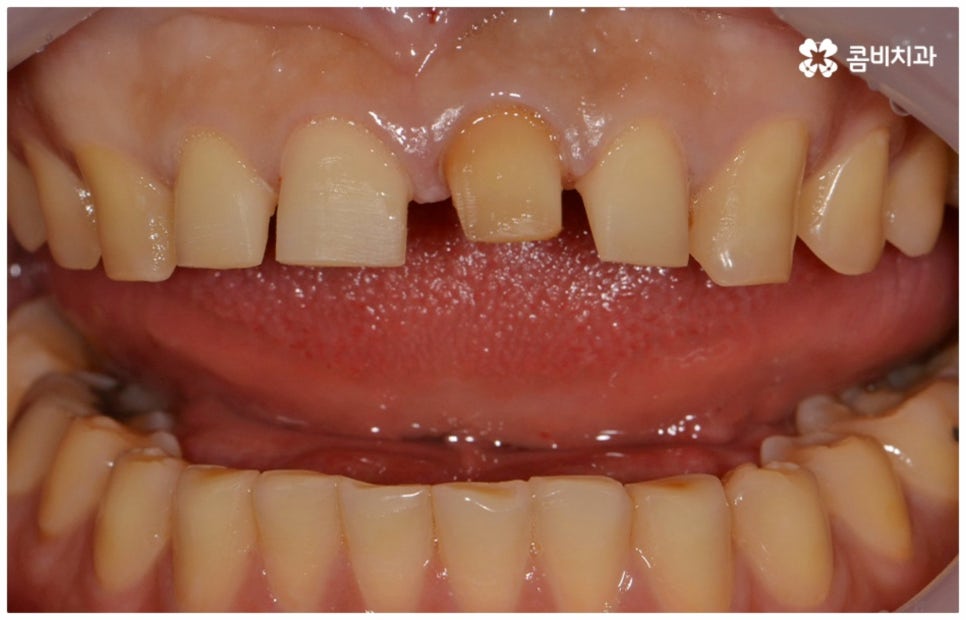 앞니충치치료 어떻게 이뤄지나요 관련 이미지 5