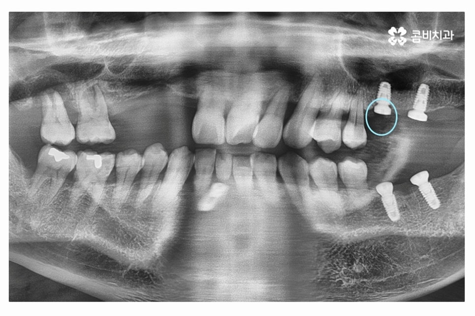 임플란트 수술 신중하게 결정하려면 관련 이미지 3