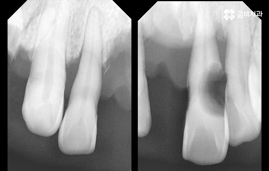 치주염 발치 이렇게나 심각하네요 관련 이미지 3