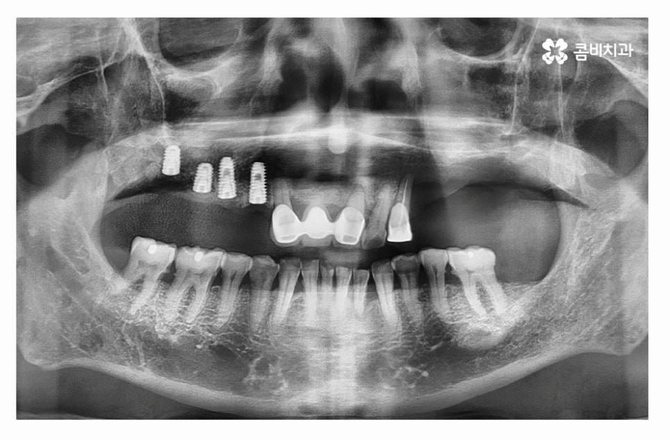 전체임플란트 신중하게 결정하려면 관련 이미지 3
