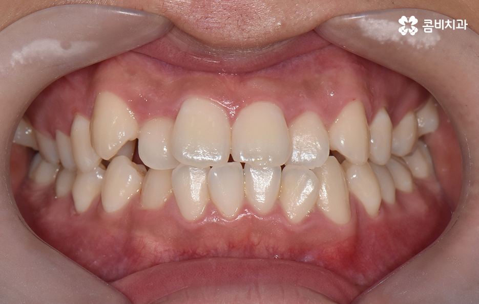 30대 치아교정 빨리 끝내고 싶어요 관련 이미지 1