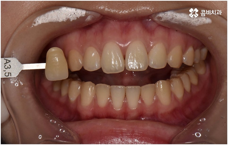 누런치아 하얗게 바꾸고 싶다면 관련 이미지 2