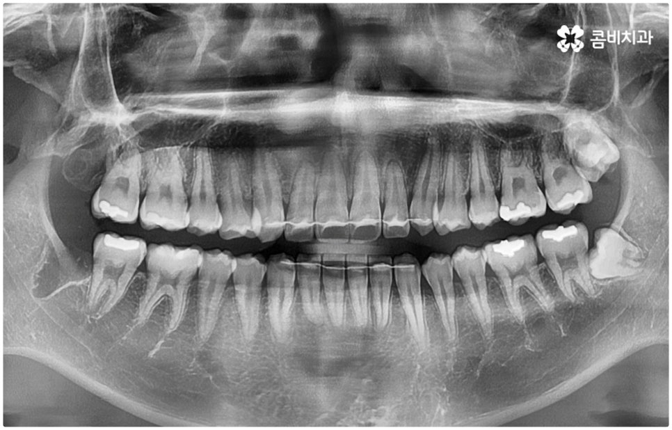 매복사랑니발치치과 어디로 가나요? 관련 이미지 10