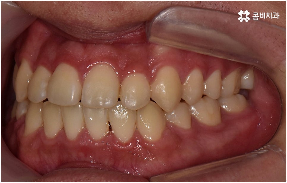 부정교합 3급 고치는 방법은 관련 이미지 13